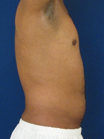 Vaser Hi Def Liposuction of the abdomen, chest, back, and flanks with fat injections to the pectoralis region 422699