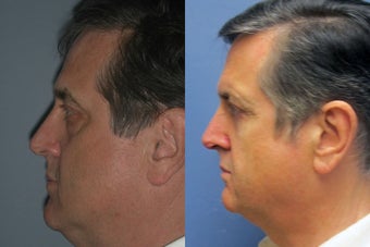 Lite Lift™ after 523718