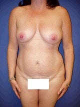 Tummy Tuck (Abdominoplasty), Breast Augmentation, Mommy Makeover before 394820