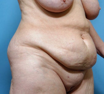 Tummy Tuck before 264553