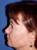 Eyelid Surgery (Blepharoplasty), Face Lift 636495