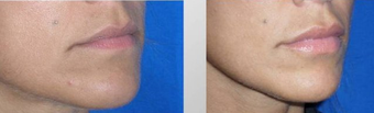 Lip Augmentation before 167639