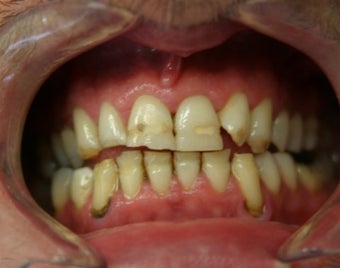 smile makeover with porcelain veneers before 625416