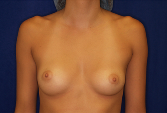 Breast Augmentation before 335967