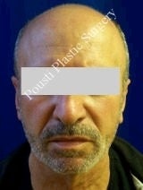 Ear Surgery (Otoplasty) 584571