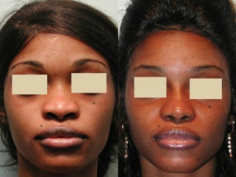 African American Rhinoplasty after 135818