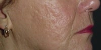Smoothbeam laser before 272011