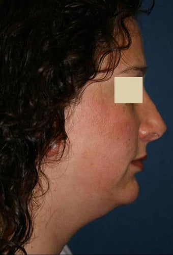 Liposuction face before 138117