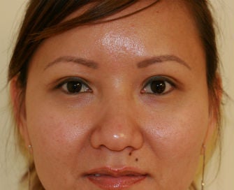Double Eyelid procedure after 378907