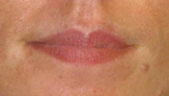 Juvederm Lip Augmentation before 84412