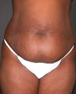 Tummy Tuck with Flank Liposuction before 330902