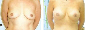Breast augmentation before 238094