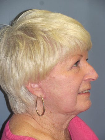 Neck Lift, Platysmaplasty 634731