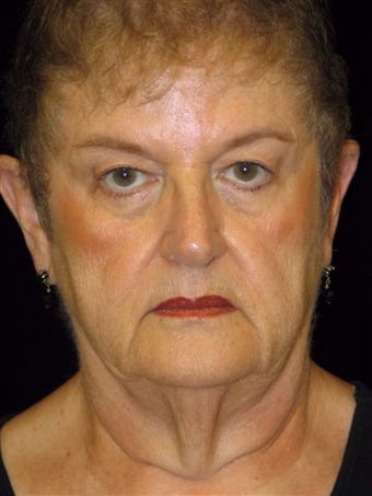 Complete faclift before 247360
