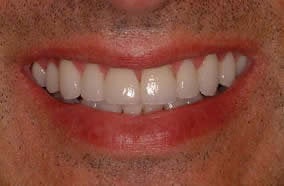 Complete Smile Makeover after 96896