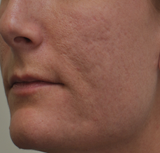 Acne Scarring 426028