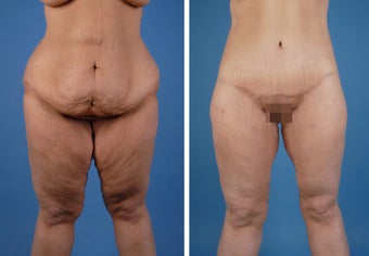 Lower Body Lift and Thighplasty before 335986