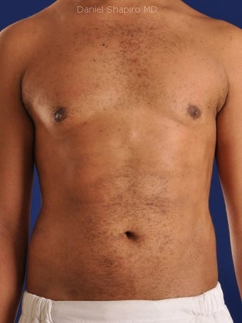 Vaser Hi Def Liposuction of the abdomen, chest, back, and flanks with fat injections to the pectoralis region after 422699