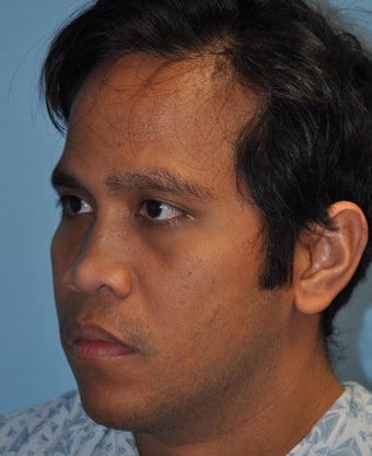 Rhinoplasty-Asian before 370619