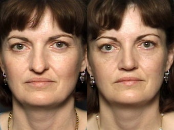 Nose Surgery before 338473
