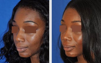African American Rhinoplasty 495714