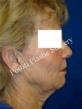 Face Lift, Neck Lift 632177