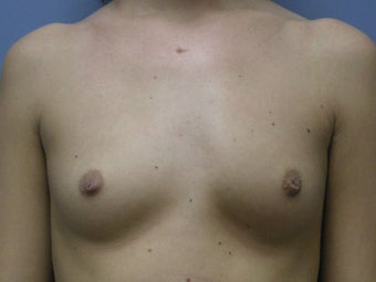Breast Augmentation before 510237