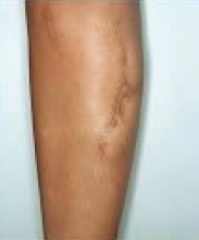 Scar revision of leg before 316562