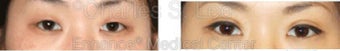 Blepharoplasty before 427714