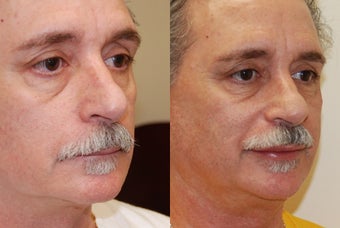 Lip Augmentation with Silikon-1000 before 378276