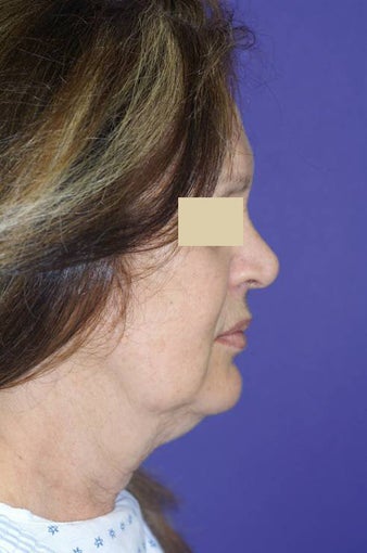 Neck sling procedure before 135676