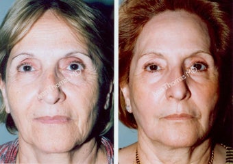Non-Surgical Face Lift- Exoderm before 242999