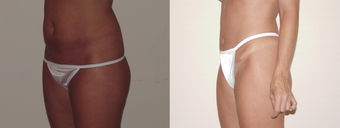 Mini abdominoplasty 377269