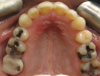 Invisalign 437118