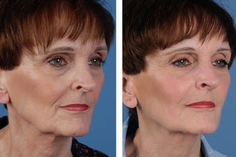 Juvederm Plus after 356494