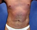 Liposculpture, Liposuction for men after 151083