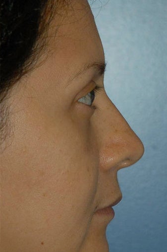 Upper and lower lid blepharoplasty and Fat Transfer to lower lids and midface 307125