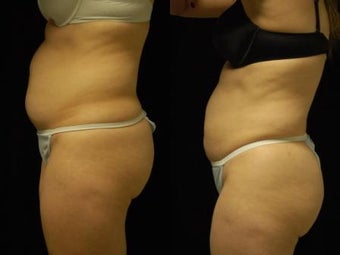 Smartlipo MPX abdomen, waist and flanks after 413234