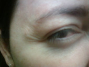 Botox Cosmetic, Crow's Feet before 127172