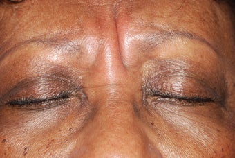 Botox for frown lines before 119388