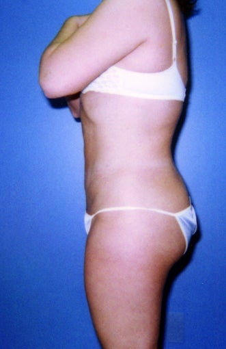 liposuction of abdomen and flanks of woman from Los Angeles 583292