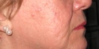Smoothbeam laser after 272011