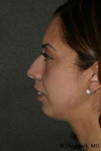 Chin Augmentation before 565883