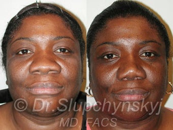 African American Rhinoplasty before 525577