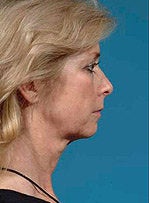 Face/neck/brow lift, upper/lower eyelid surgery 458800