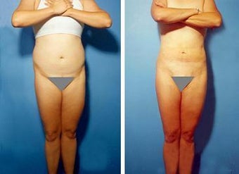 Liposuction before 636218