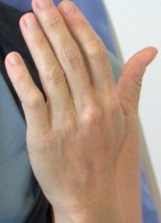 Radiesse Hand Rejuvenation after 371749