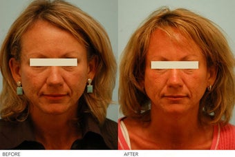 Acne Scarring Correction before 136792