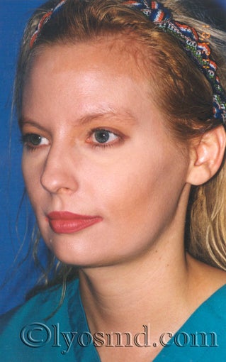 Endoscopic Browlift, Liposuction of the Neck and Jawline - Facelift after 224866