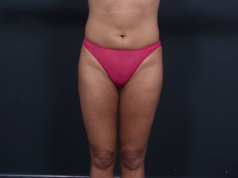 Liposuction after 462488